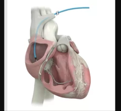 The OmniaSecure defibrillation lead, which Medtronic describes as “the world's smallest transvenous defibrillation lead,” has a size of just 4.7 French. 