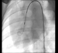 Impella ECP heart pump insertion Abiomed Johnson & Johnson MedTech