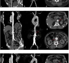 Deep learning recons reduce contrast and radiation doses in aortic CTA