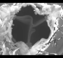 Redo TAVR: A 26-mm Sapien 3 device (Edwards Lifesciences) implanted within a 29-mm CoreValve device (Medtronic). Image courtesy of EuroIntervention. 