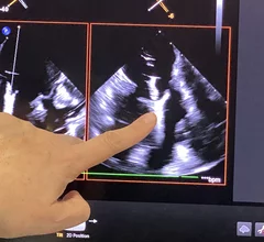 Abbott TriClip tricuspid edge-to-edge repair (T-TEER) device shown on transesophageal echo (TEE). The device clips together the leaflets of the valve to form a better seal and reduce regurgitation without the need for open heart surgery. Photo by Dave Fornell