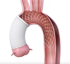 Artivion, an Atlanta-based medical device company, has received a Humanitarian Device Exemption (HDE) from the U.S. Food and Drug Administration (FDA) for its AMDS Hybrid Prosthesis designed to treat DeBakey Type 1 dissections when malperfusion occurs. This HDE ensures select patients can be treated with the device before the FDA makes its final approval decision.