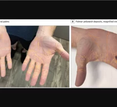 Following a high-fat diet impacted one middle-aged man’s cardiovascular health so much that cholesterol appeared to start leaking out of his hands. 