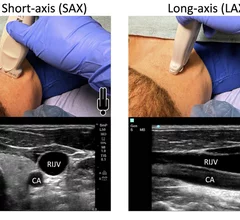 Figure from the new ASE guideline for ultrasound guided vascular access, showing vessel and probe orientation on the transverse plane short axis (SAX) view perpendicular to the vessels, or in longitudinal long axis plane (LAX) coaxial to the vessels. Image courtesy of ASE