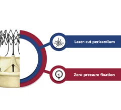 Corcym has received U.S. Food and Drug Administration (FDA) approval for a new version of its Perceval Plus surgical aortic heart valve that includes the company’s advanced LANCELOT features. 