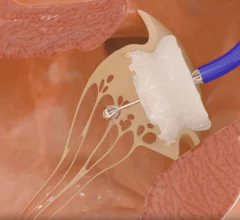 Capstan Medical robotic transcatheter mitral valve replacement