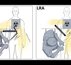 Using a left radial artery (LRA) vs. hyper-adducted right radial artery (HARRA) approach in the cath lab