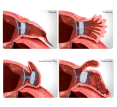 Amplatzer Amulet Left Atrial Appendage Occluder (LAAO) from Abbott 