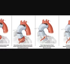Society of Thoracic Surgeons shares new risk calculator for aortic surgeries