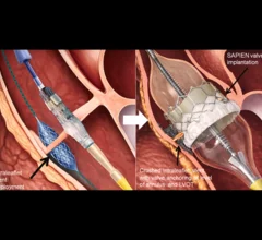 After traversing the aortic cusp with an electrified wire and balloon inflation, a stent is positioned inside the noncoronary cusp and deployed. Immediately after, a transcatheter aortic valve is expanded, and the stent is crushed on the left ventricular outflow tract wall and annulus, while anchored to the aortic valve leaflet. 