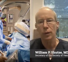 William P. Shutze, MD, FACS, secretary of the Society of Vascular Surgery (SVS), a vascular surgeon with Texas Vascular Associates in Plano, Texas, and a clinical associate professor of medicine at Texas A&M College of Medicine, explained the role of vascular surgeons in peripheral artery disease (PAD) and critical limb ischemia (CLI). 