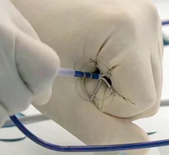 Pulse Biosciences nPulse nanosecond pulsed field ablation (nsPFA) system uses 5‑second applications to create lesions and does not require catheter repositioning.