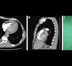Accidentally swallowing a sewing needle could have cost one 54-year-old patient his life. His care team was persistent, however, exploring his unexplained symptoms until they identified the problem.