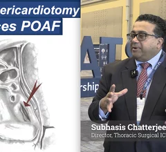 Subhasis Chatterjee, MD, FACS, FACC, FCCP, Associate Professor of Surgery, Director Thoracic Surgical ICU and ECMO Program, Baylor St. Lukes, explains the new 2026 guidelines for management of new onset post-operative atrial fibrillation (AFib), which he spoke about at the American Association for Thoracic Surgery (AATS) 2026 annual meeting.