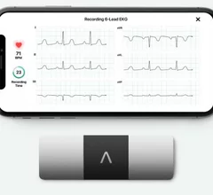 The AliveCor KardiaMobile 6-lead ECG remote monitoring system.