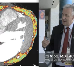 Ed Nicol, MD, FACC, FSCCT, MBA, FRCP, FRCR, FRAeS, head of cardiovascular CT, Royal Brompton Hospital, London, United Kingdom, and former president of the Society of Cardiovascular Computed Tomography (SCCT), explains some of the new technologies being developed to expand cardiac CT as a diagnostic tool.
