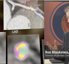 Ron Blankstein, FACC, FASNC, FSCCT, FASPC, director of cardiac computed tomography, Brigham and Women's Hospital, and professor of medicine, radiology, at Harvard Medical School, explains how cardiac imaging departments need to plan for the involved process of integrating artificial intelligence (AI) algorithms into clinical practice. #SCCT #YesCCT
