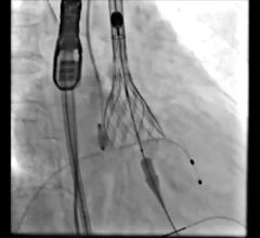The NCPI-plus TAVR technique
