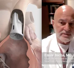 Emile Bacha, MD, chair, Department of Surgery, surgeon-in-chief at NewYork-Presbyterian Hospital / Columbia University Medical Center, and past president of the American Association for Thoracic Surgery (AATS), was a lead investigator in the clinical trial that led to the recent U.S. FDA approval for the Edwards Lifesciences Autus size-adjustable pulmonary valve. 