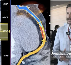 Jonathon Leipsic, MD, MSCCT, FRCPC, chairman of radiology, and a professor of radiology and cardiology, University of British Columbia, Canada, explains some of the key technical developments in coronary CT angiogram (CCTA) plaque imaging, which has seeing rapid adoption. #SCCT #TCT #YesCCT