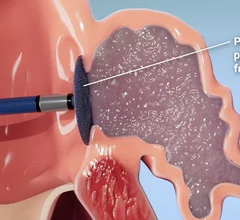 The Parasol Med Tech left atrial appendage closure (LAAO) system uses gel to completely fill and seal the LAA while a temporary shield prevents the gel from embolizing during delivery.