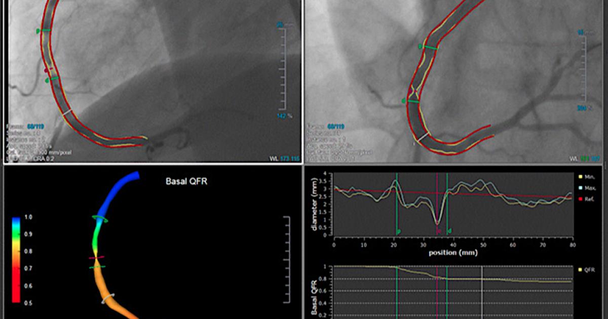 FFR-angiography guided lesion selection for PCI improves two-year