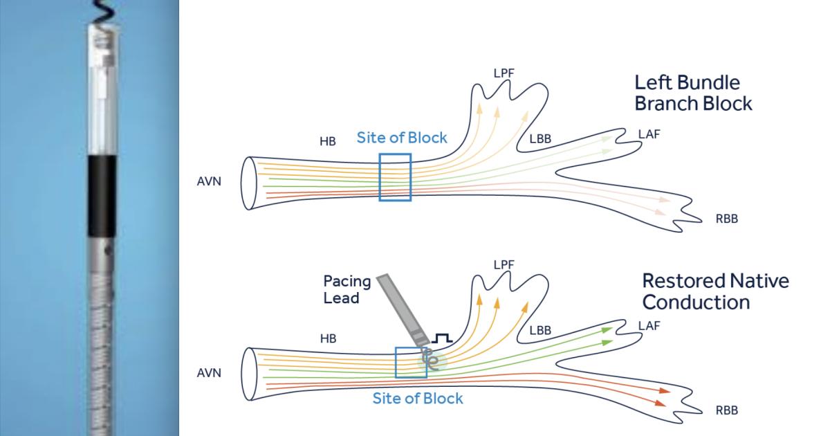 Medtronic cardiac lead the first to receive FDA approval for 