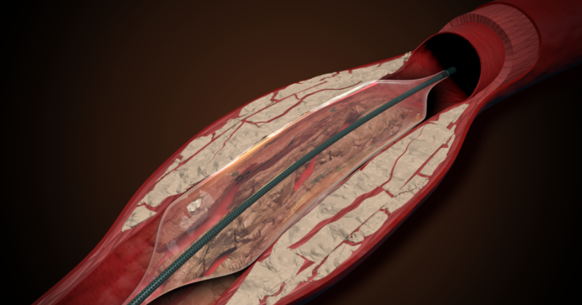 Stryker enters competitive IVL space with acquisition of Amplitude Vascular Systems