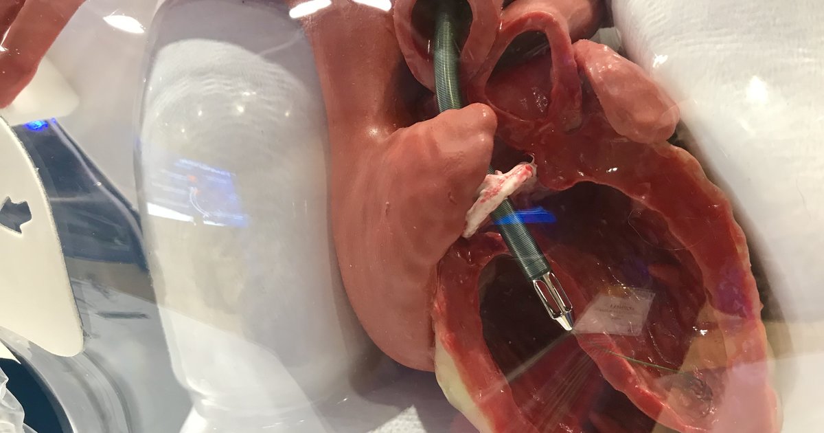 Impella 5.5 shows promise in certain non-shock, high-risk cardiac surgery patients