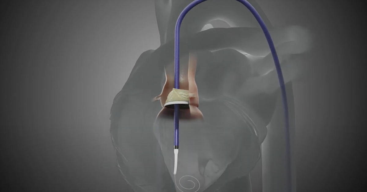 First Tavr Cardiologists treat first commercial patients with FDA-cleared valve-in ...