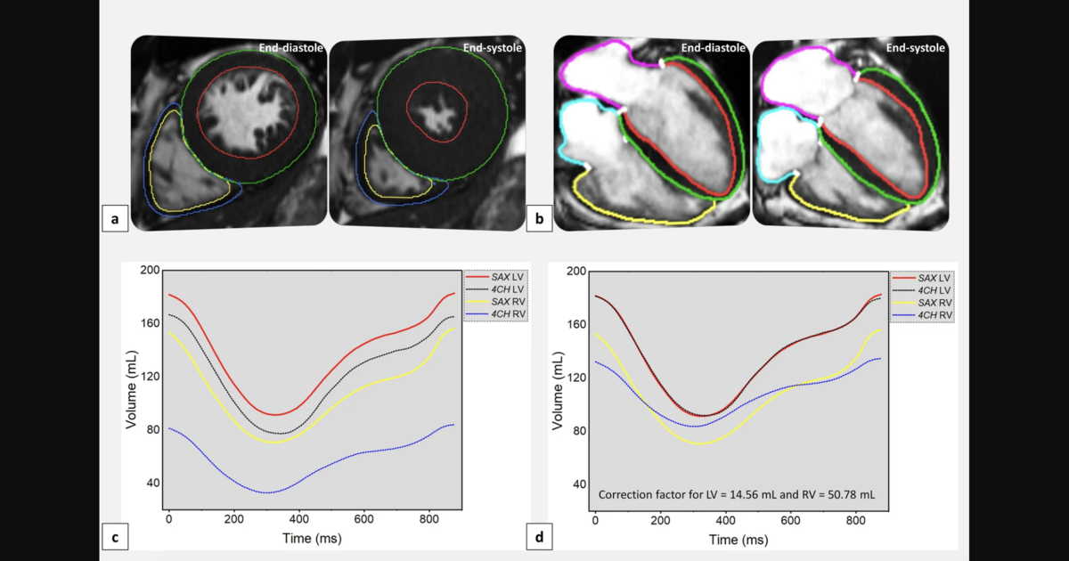 AI creates accurate 4D heart scans in seconds