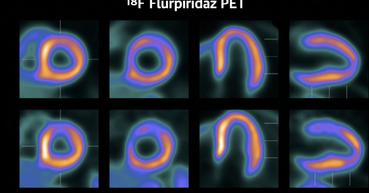 FDA approves GE HealthCare’s flurpiridaz F-18 PET radiotracer for CAD