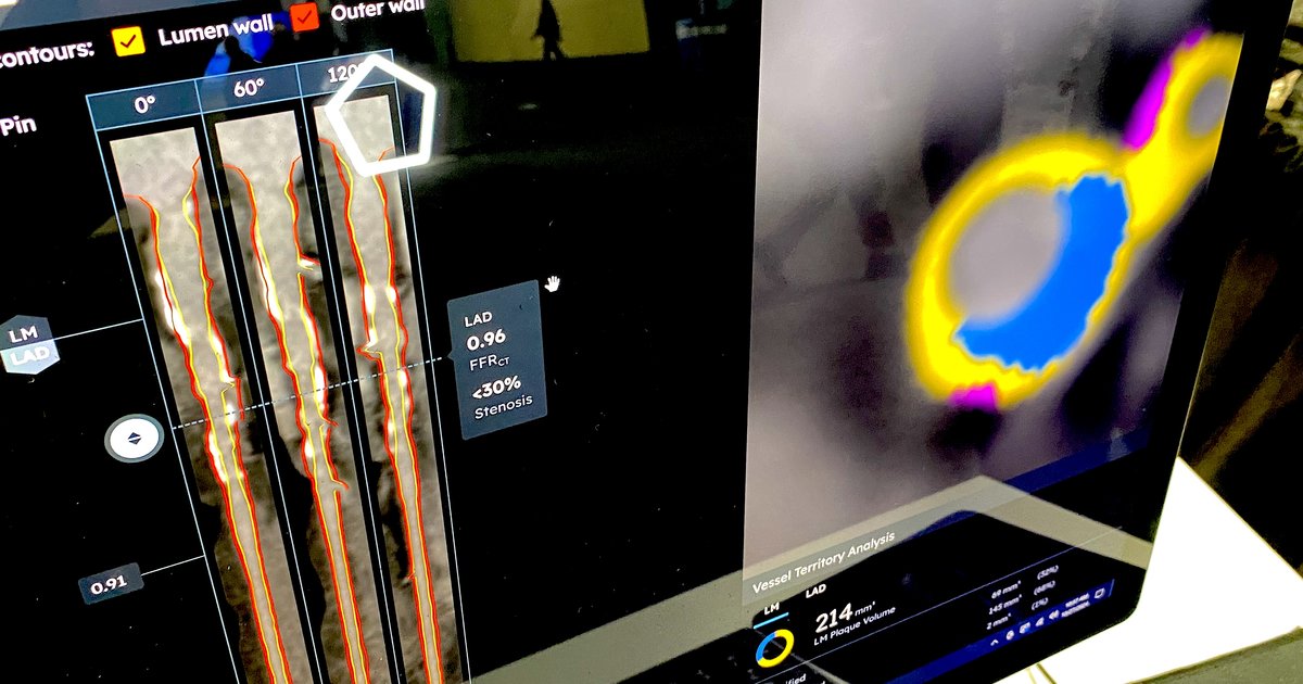 Reimbursement expected to drive implementation of CCTA, coronary plaque analysis