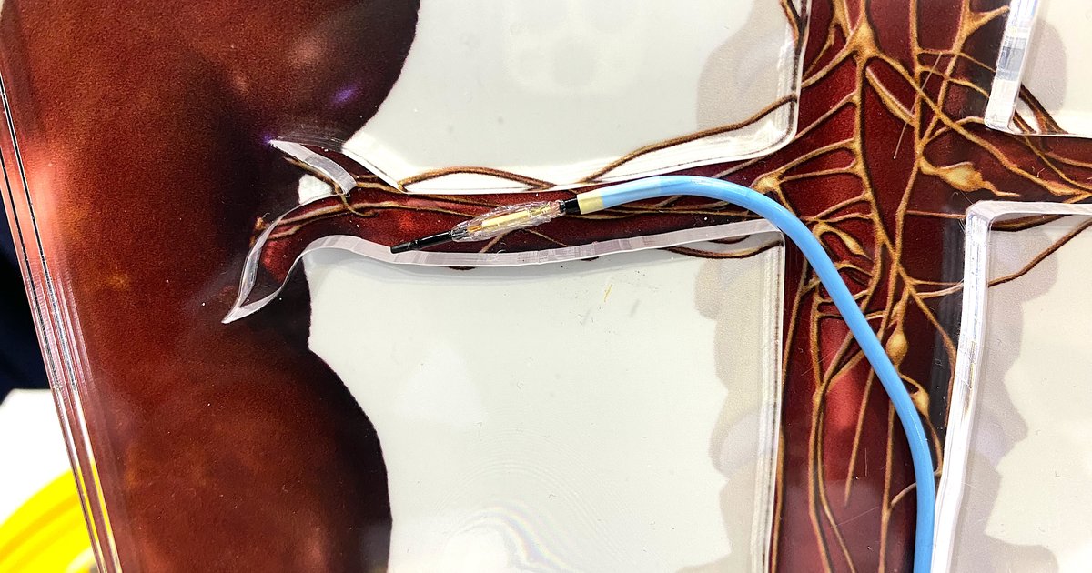 Renal denervation systems from Recor Medical, Medtronic receive new ...