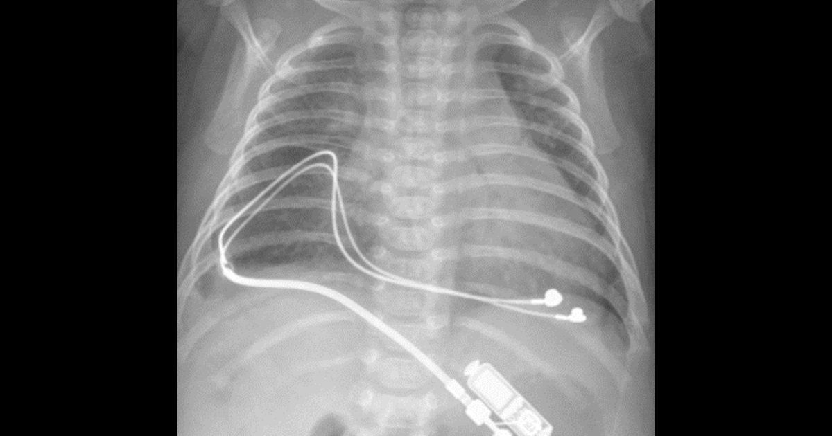 Paediatric Pacemaker Position ‘A new alternative’: Tiny pacemakers for infants show early promise