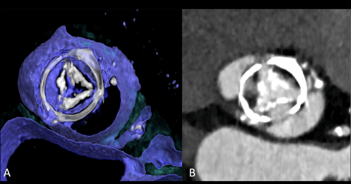 Cardiologists, radiologists and surgeons share ‘landmark’ document on ...