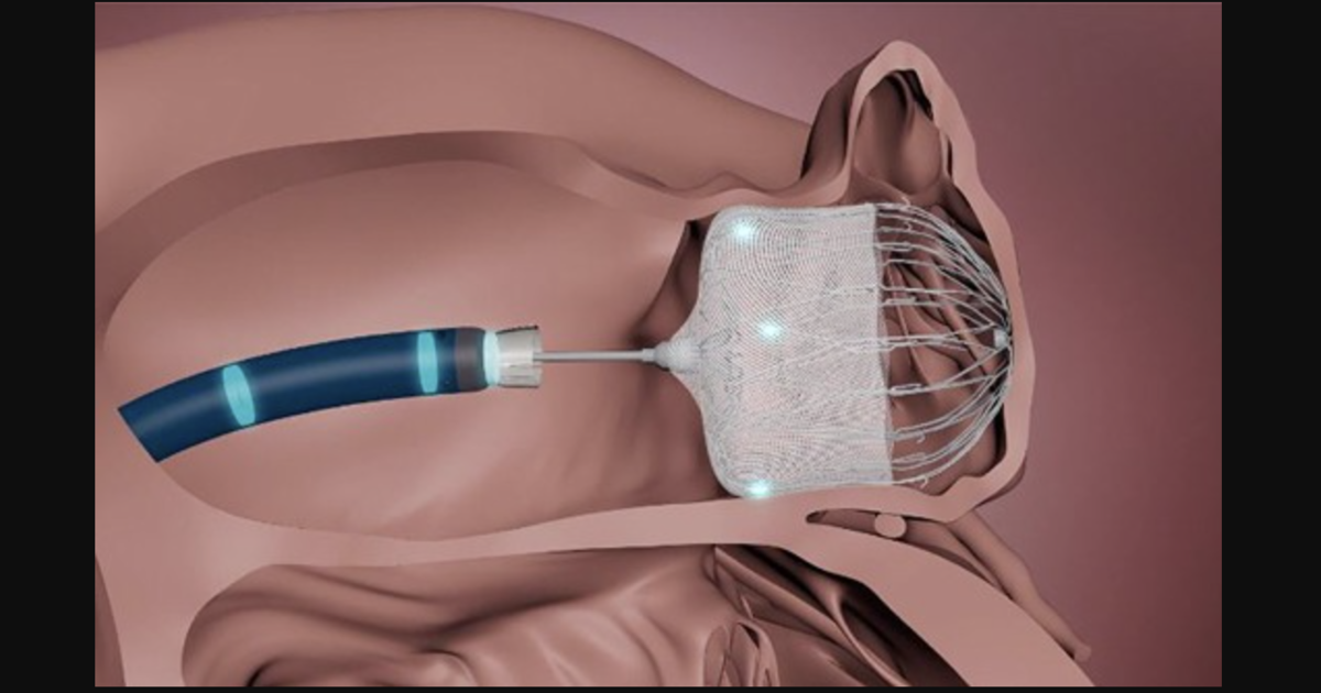 FDA says Watchman access systems may increase risk of air embolism—17 ...