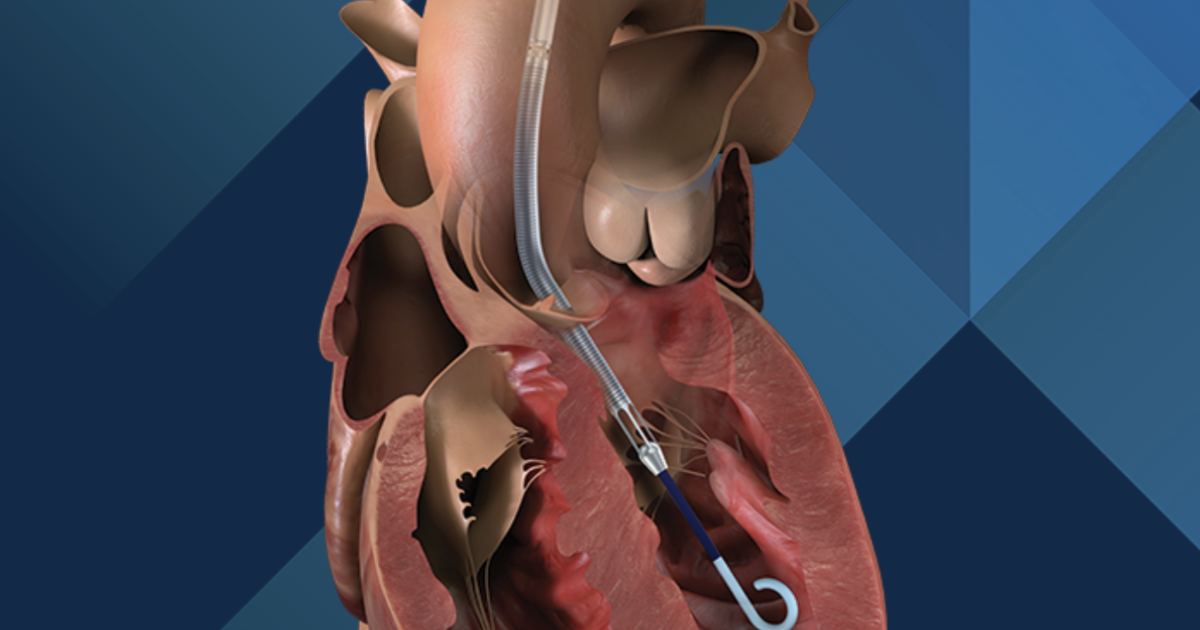 FDA shares another warning about Impella heart pumps after death