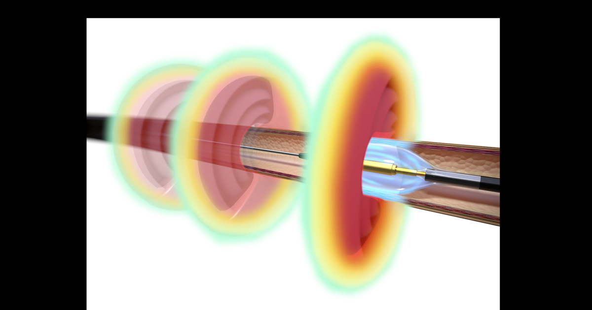 More good news for renal denervation: FDA-approved systems linked to ...