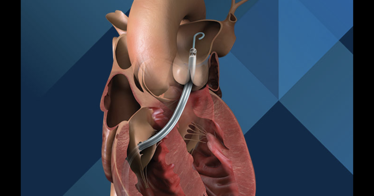 FDA warns that Johnson & Johnson heart pump sensors may malfunction—22 injuries reported