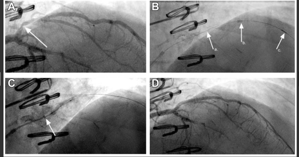Cathro Extensions Next-generation guide extension catheter delivers value during complex PCI