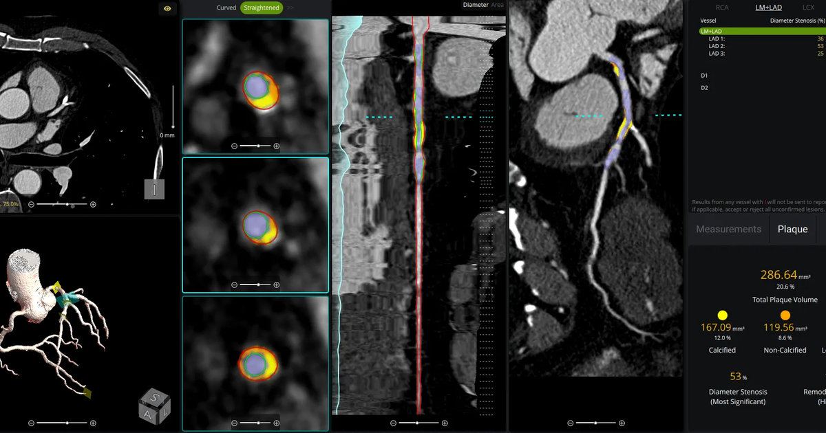 How to implement AI-powered coronary plaque analysis software—and ensure you get paid
