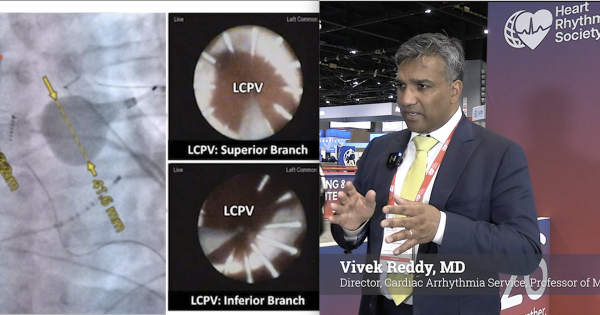 Exploring the latest data in PFA and leadless conduction system pacing