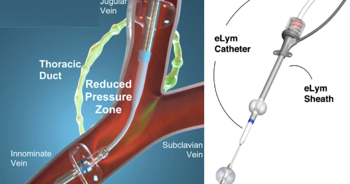 First-of-its-kind drainage device helps limit heart failure rehospitalizations