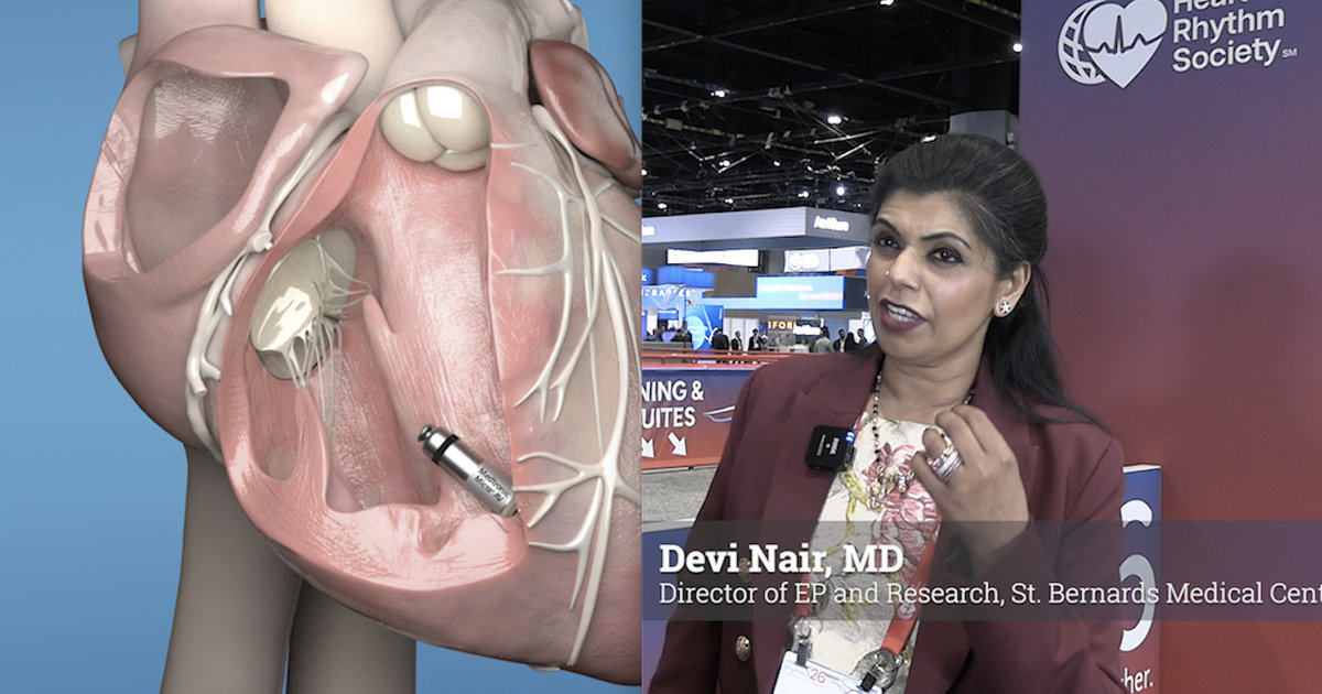 Advances in leadless conduction and Bachmann’s bundle pacing next frontier in physiologic pacing