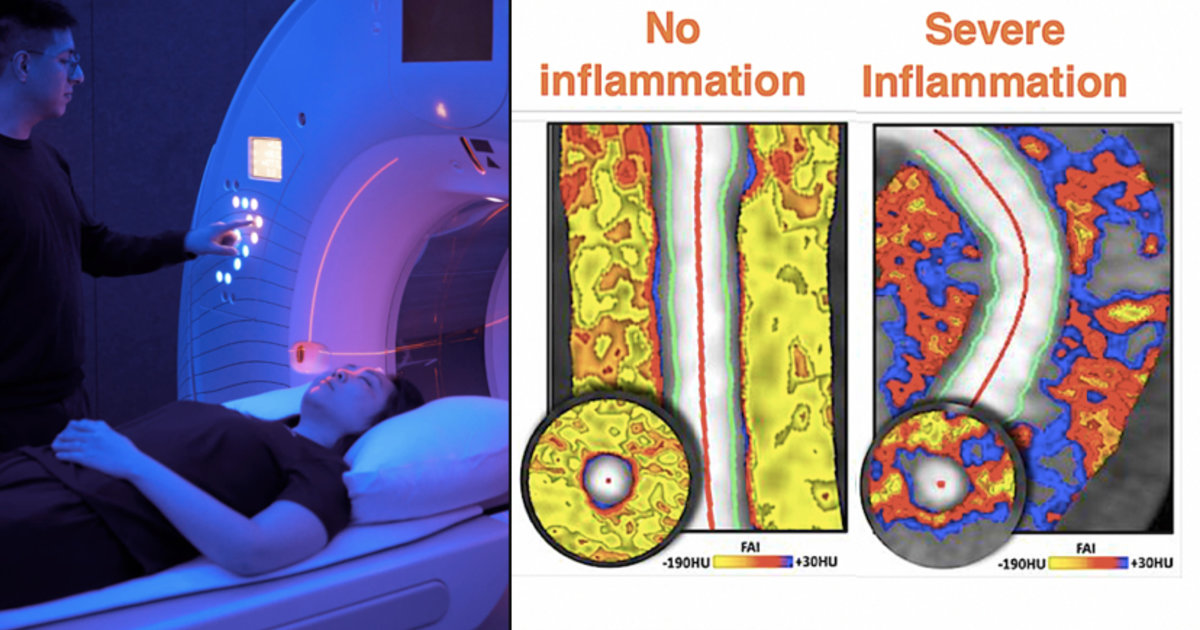 AI tech detects high-risk coronary inflammation in many asymptomatic ...