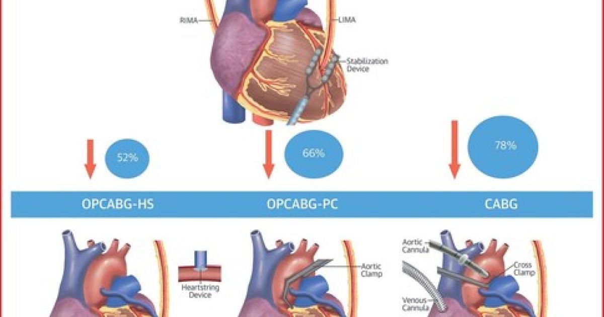 Beating-Heart, Off-Pump Coronary Artery Bypass Surgery - UChicago