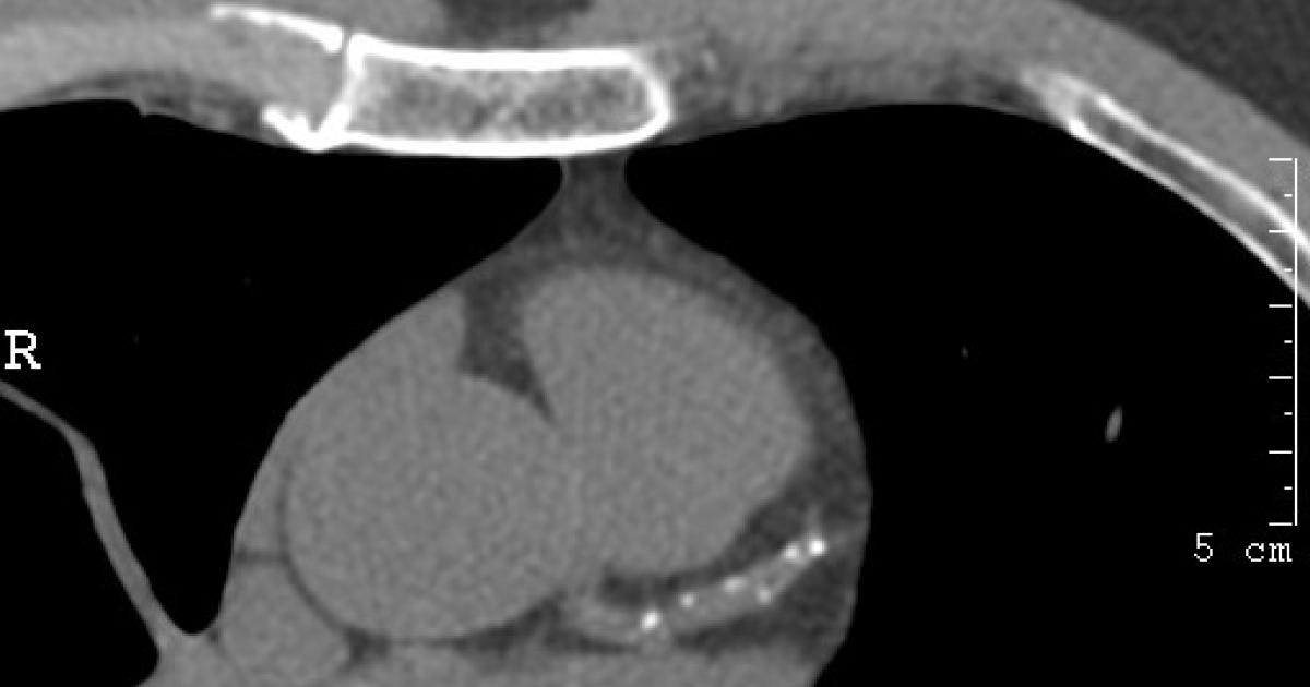 heart test in lower Dense plaque artery heart disease may coronary risk