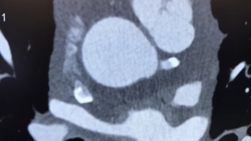 Example case of photon-counting cardiac CT shown by Siemens at it booth today at the American College of Cardiology (ACC) 2022 meeting. The Naeotom Alpha system gained FDA approval in 2021 and is the first photon-counting CT scanner commercially approved. The technology enables all scans to be multi-energy spectral scans because photons of different energies are binned so different energies renderings can be shown. It also allows removal of specific elements, so calcium or metal implants can be removed or