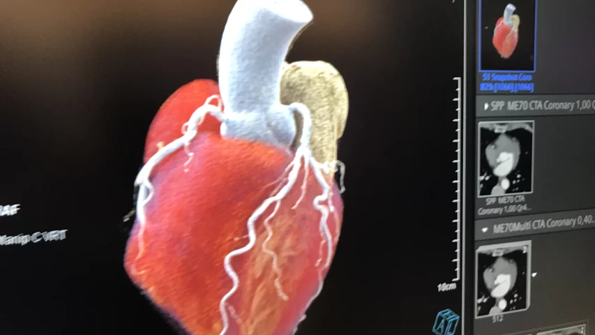A 3D rendering of a patient's heart from a photon counting CT system in the Siemens booth. The vendor became the first to commercialize a photon-counting CT scanner in 2021, with the approval of the Naeotom Alpha. It can reduce radiation dose, produce clearer images and bins photos by energy to create spectral imaging capabilities on all scans. 
